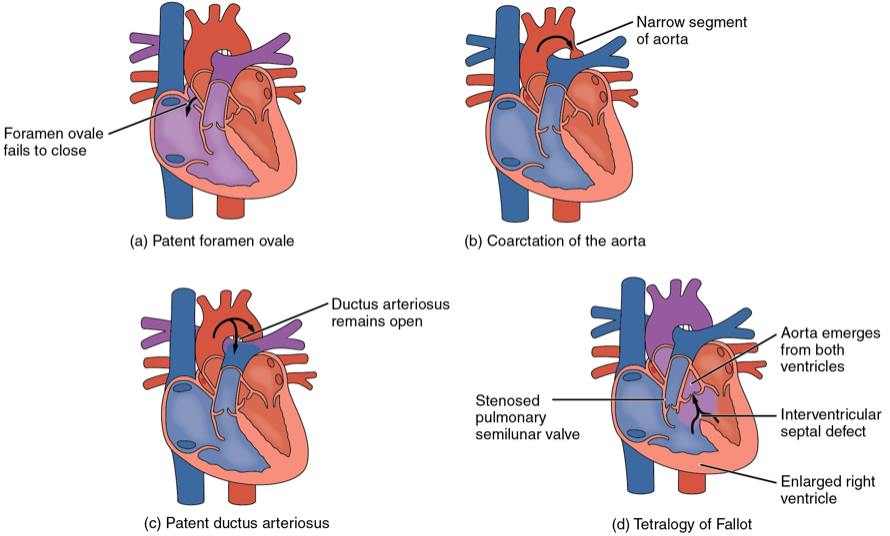 Congenital Heart Disease In Adults 3 Complex Defects Online Learning 2014